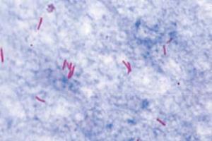 Positive sputum (<i>Mycobacterium tuberculosis</i>)