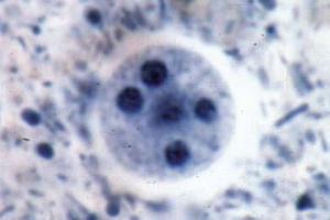 <i>Entamoeba histolytica</i> smear showing cysts