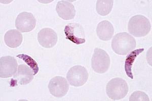 <i>Plasmodium falciparum</i> blood smear with typical ring stages